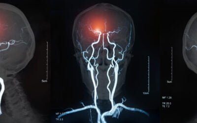 How Prehospital Stroke Care is Changing