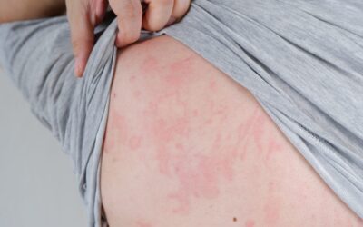 Allergic Reactions and Anaphylaxis (BLS)